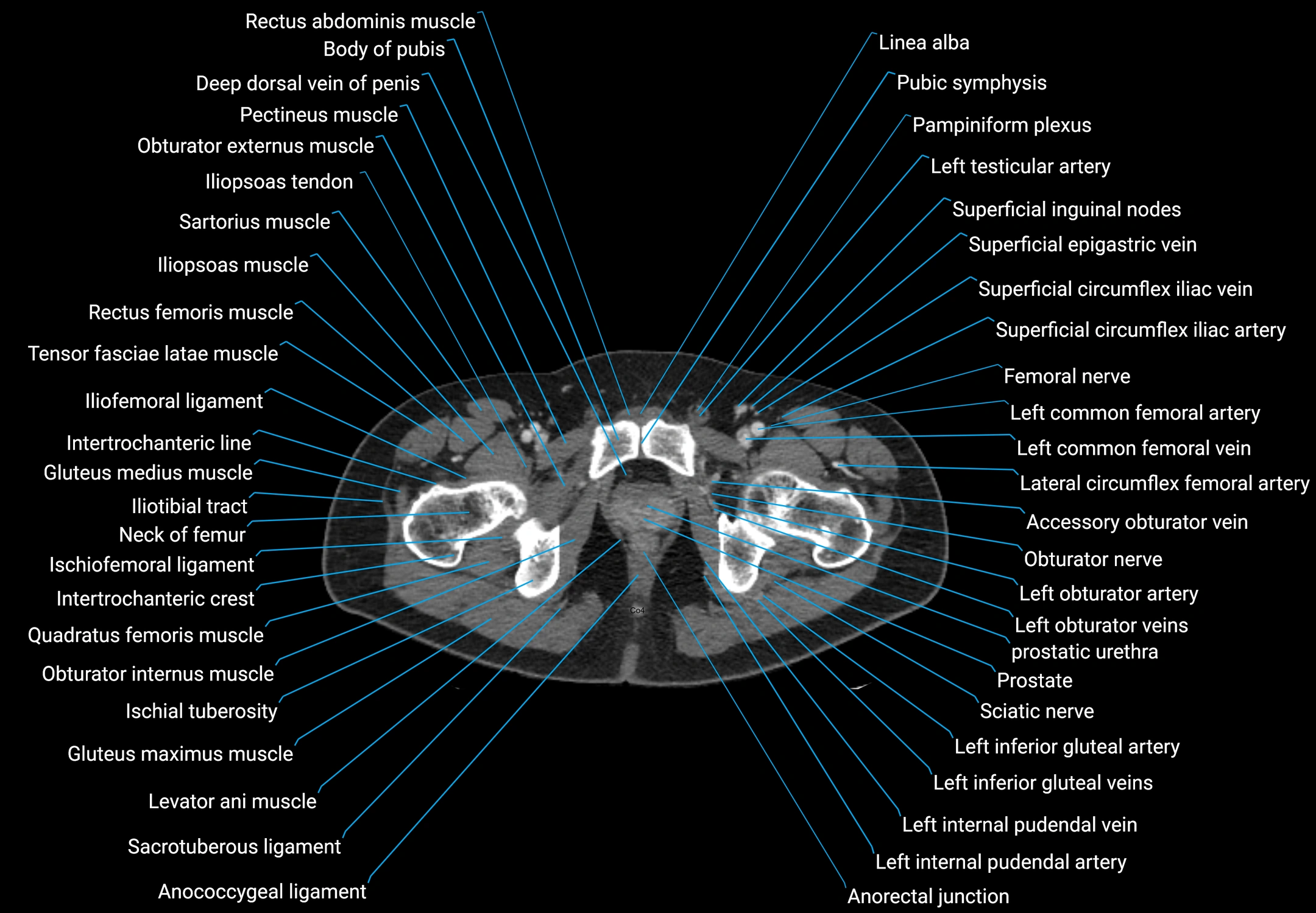CT male pelvis axial cross sectional anatomy labelled radiology image -00198.webp